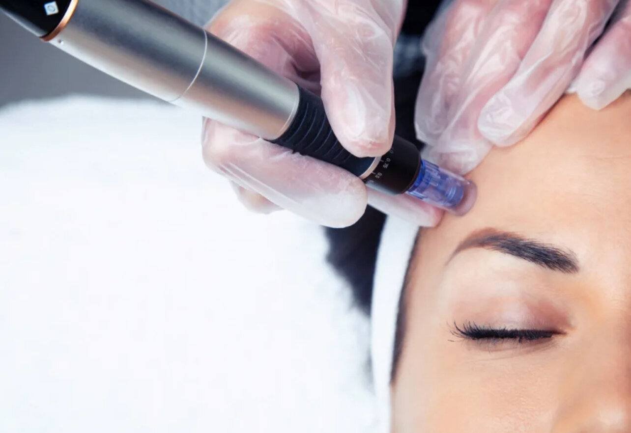Discover the Transformative Power of Mesotherapy at  NVR Aesthetics 